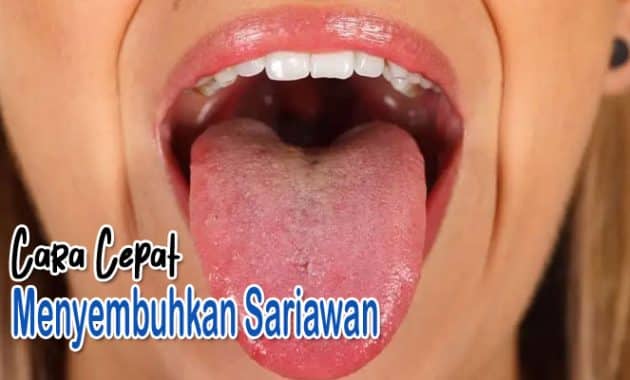 cara cepat menyembuhkan sariawan di lidah