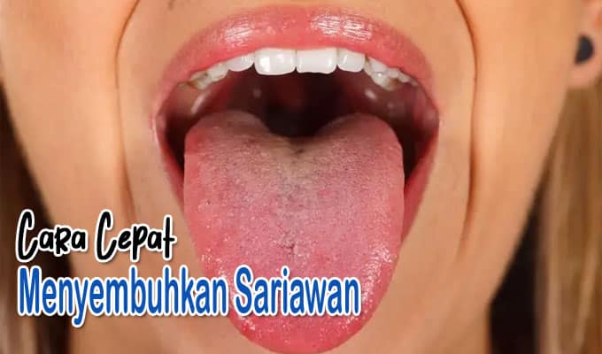cara cepat menyembuhkan sariawan di lidah